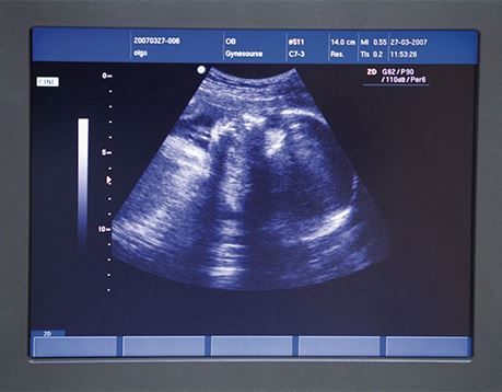 Monitor screen shows an ultrasound