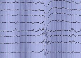 A printout of an EEG, formally known as an electroencephalography